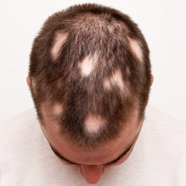 tratament alopecia areata